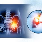 Hip Replacement in Nagpur performed by an experienced orthopedic surgeon using advanced surgical techniques