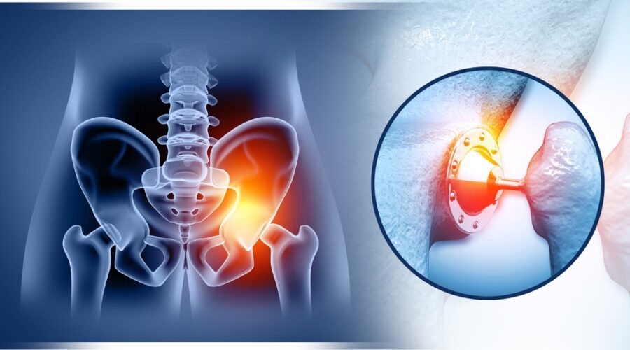 Hip Replacement in Nagpur performed by an experienced orthopedic surgeon using advanced surgical techniques