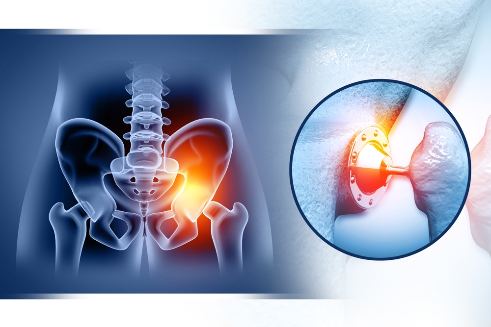 Hip Replacement in Nagpur performed by an experienced orthopedic surgeon using advanced surgical techniques