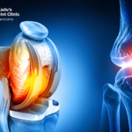 Knee Replacement Surgery Cost in Nagpur 2026