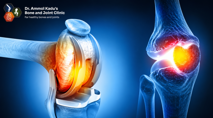 Knee Replacement Surgery Cost in Nagpur 2026