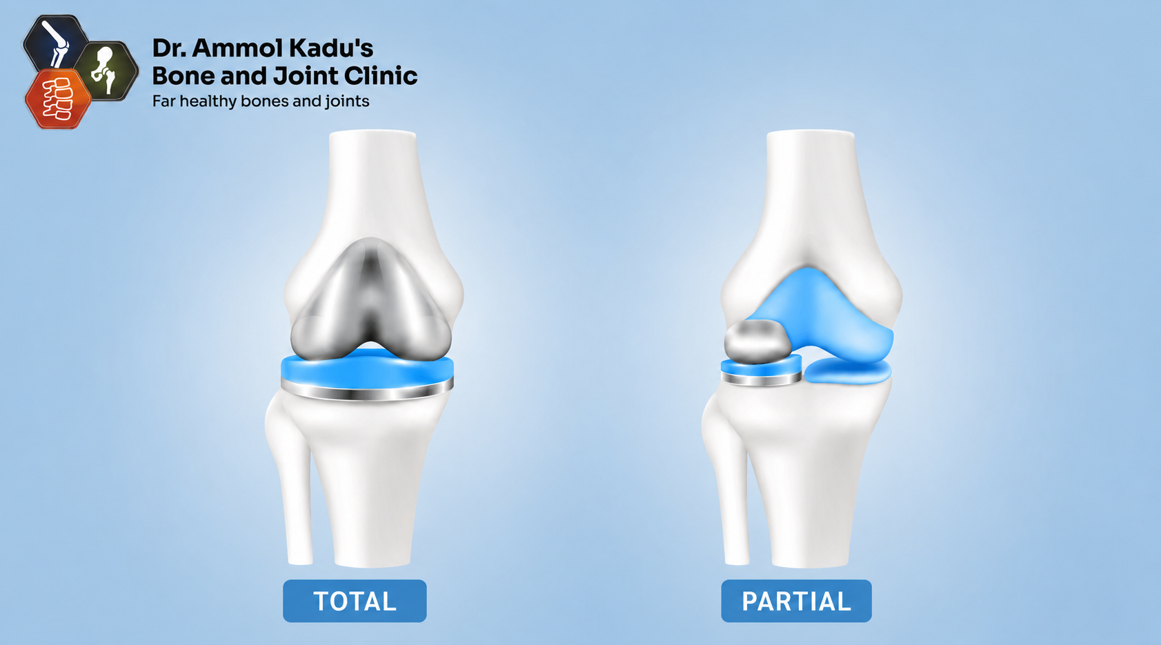 Total vs Partial Knee Replacement in Nagpur